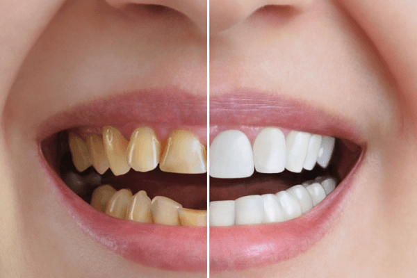 Your Complete Guide to Fluoride Treatment in Bharuch with Dr. Garvita