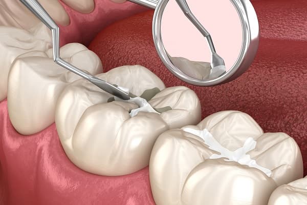 Complete Guide to Dental Sealants Treatment in New Delhi | Dr. Rajan Sethi