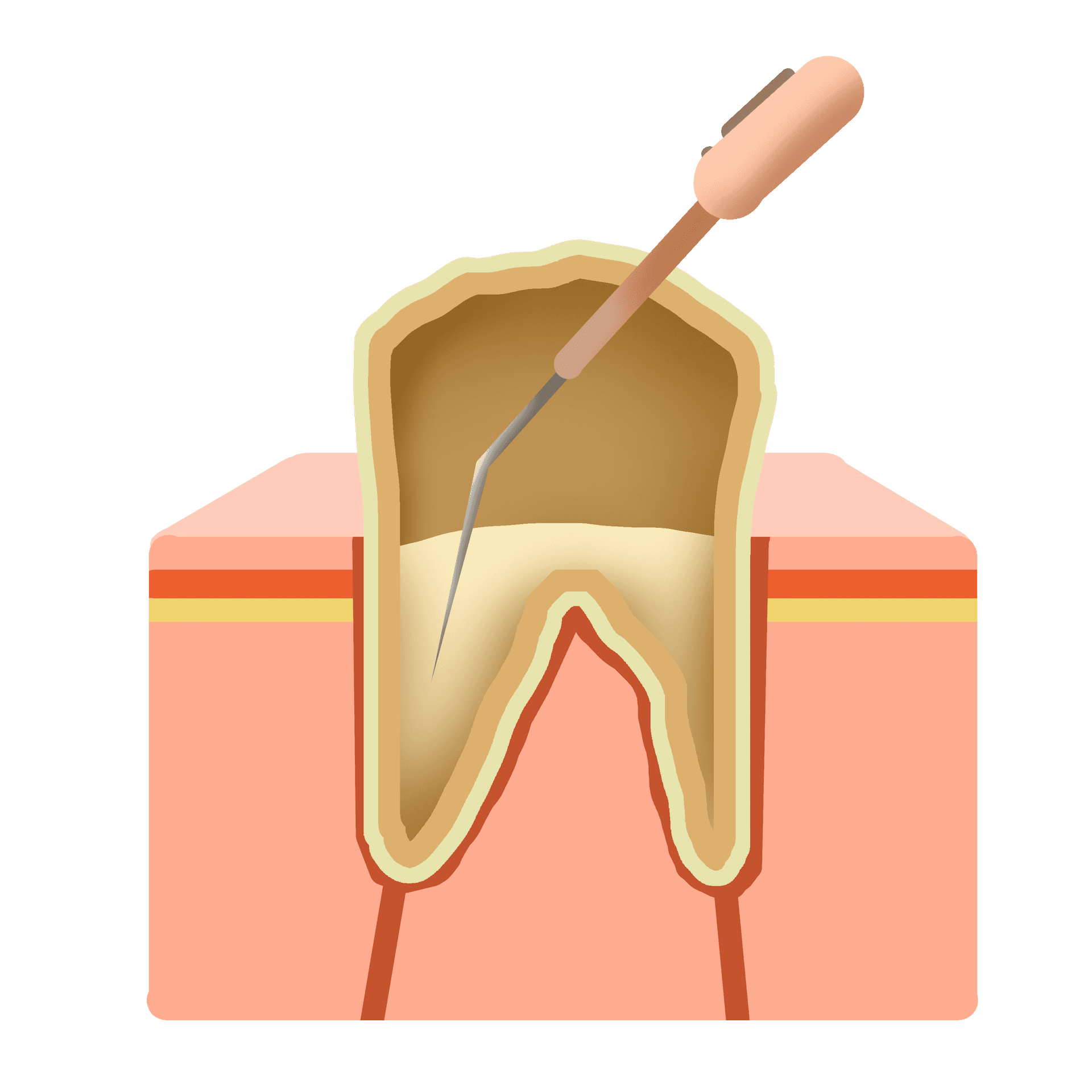 Why Choose Dr. Rajiv Ahuja for Root Canal Rct in Faridabad? - 64% Off