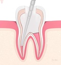 Endoking Fiber Post Refills_9.jpg