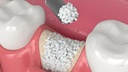 Eucare Sybograf Plus Synthetic Bone Graft_3.jpg