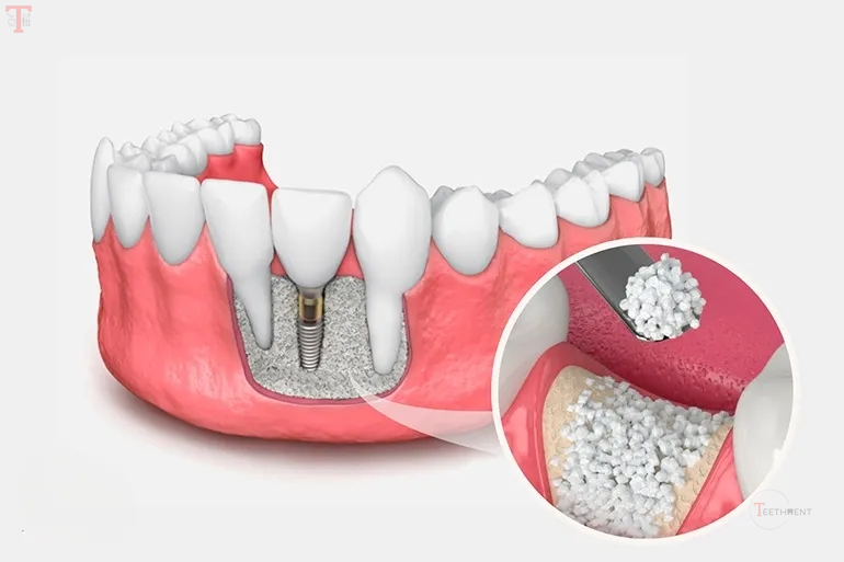 Eucare Sybograf Plus Synthetic Bone Graft_4.jpg