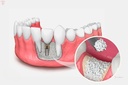 Eucare Sybograf Plus Synthetic Bone Graft_4.jpg