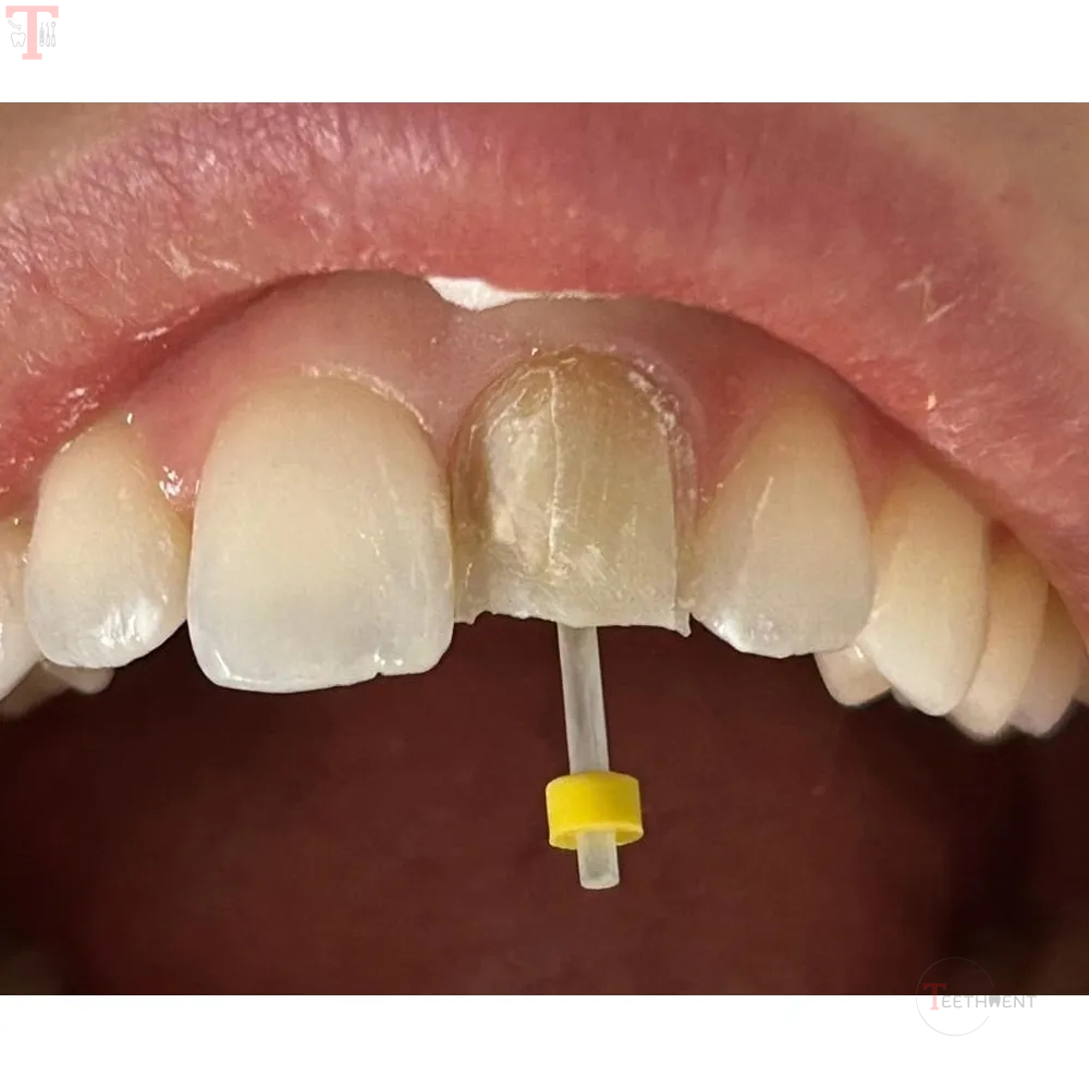 AAA Dental Fiber Post Kit Pack of 20 Posts  4 Drills_6.jpg