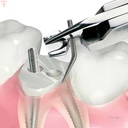 Filhol Dental Filpost Refill Pack_5.jpg
