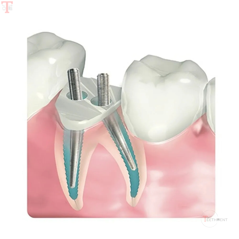 Filhol Dental Filpost Refill Pack_6.jpg