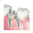 Filhol Dental Filpost Refill Pack_6.jpg