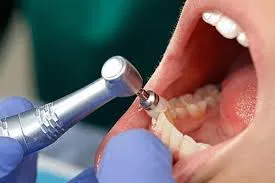 Being Foshan Contra Angle Handpiece_5.jpg