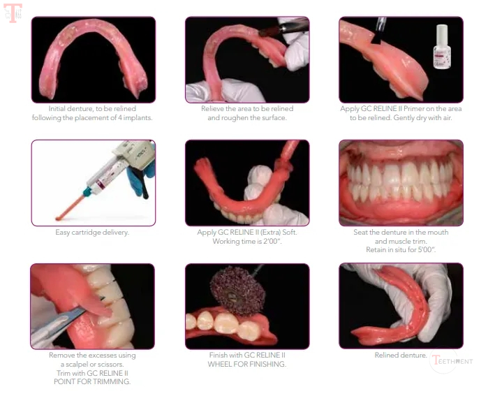 GC Reline II Soft Intro Kit_10.jpg