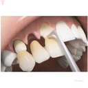GDC Automatic  Premium Crown Remover Crp_5.jpg