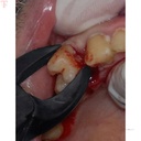 GDC Black Plasma Coated Extraction Forcep Kit_5.jpg