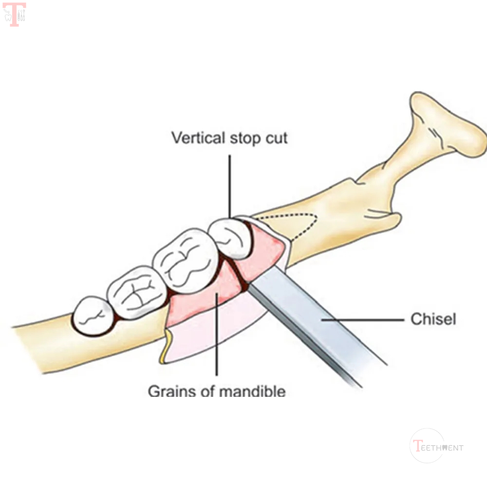 GDC Bone Chisel Gardner 3mm CG1_4.jpg