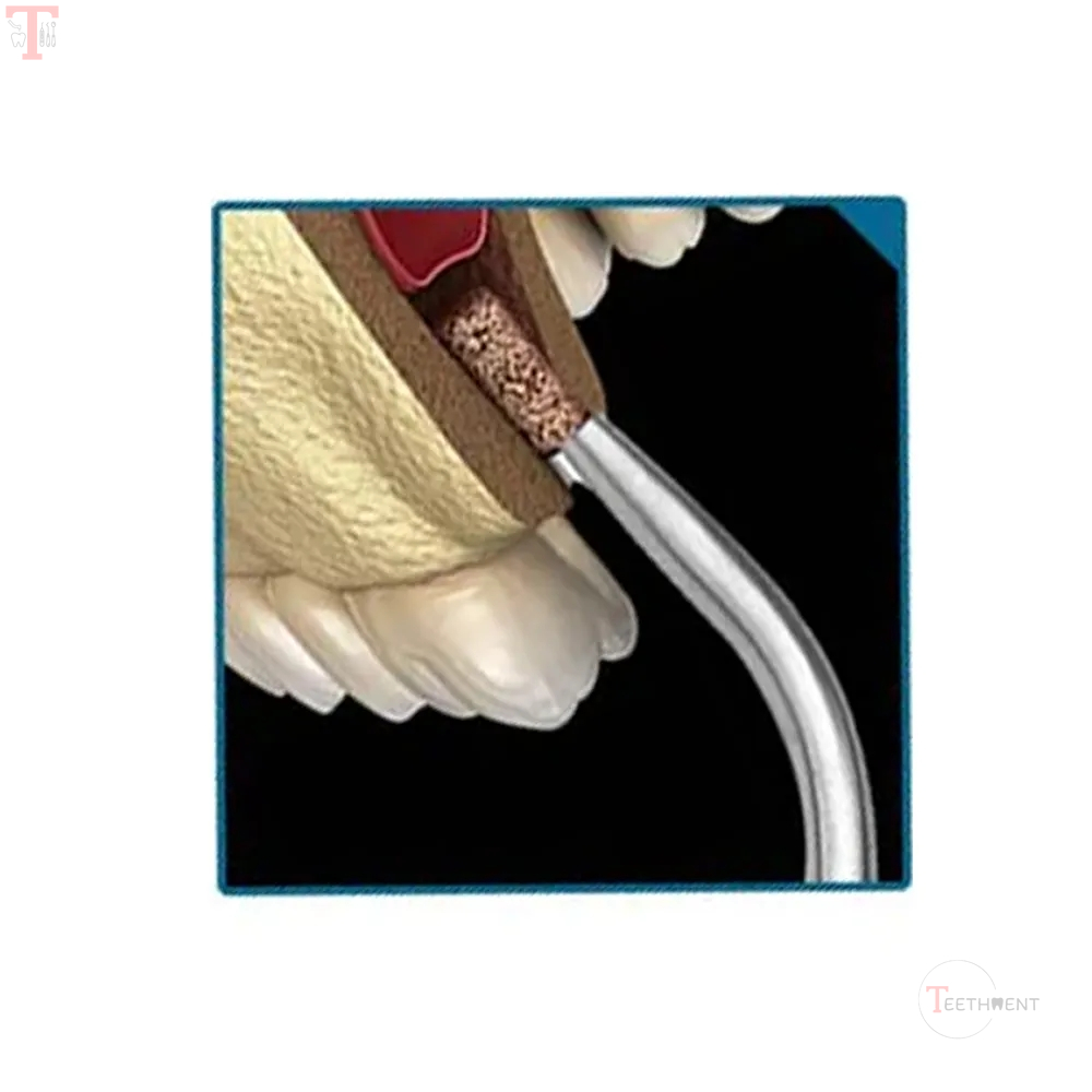 GDC Bone Collector 7mm Bc13311_4.jpg
