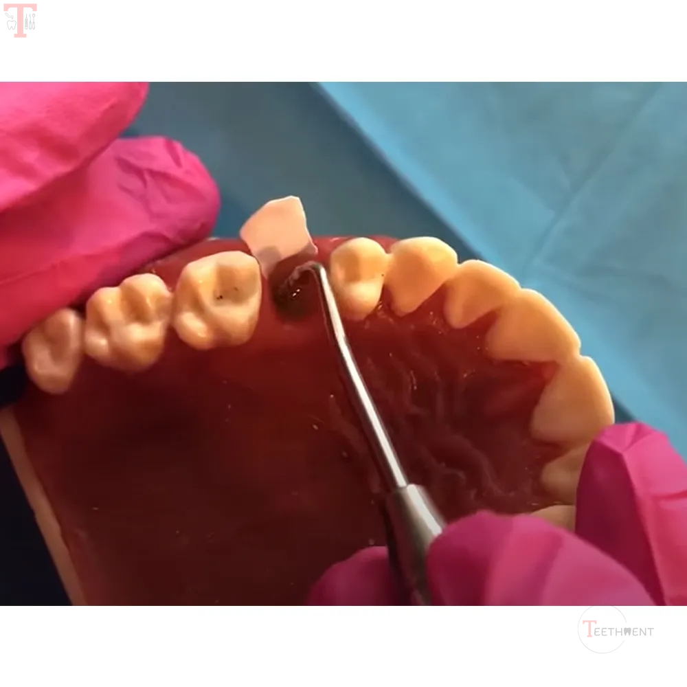 GDC Bone Grafting Instruments_7.jpg
