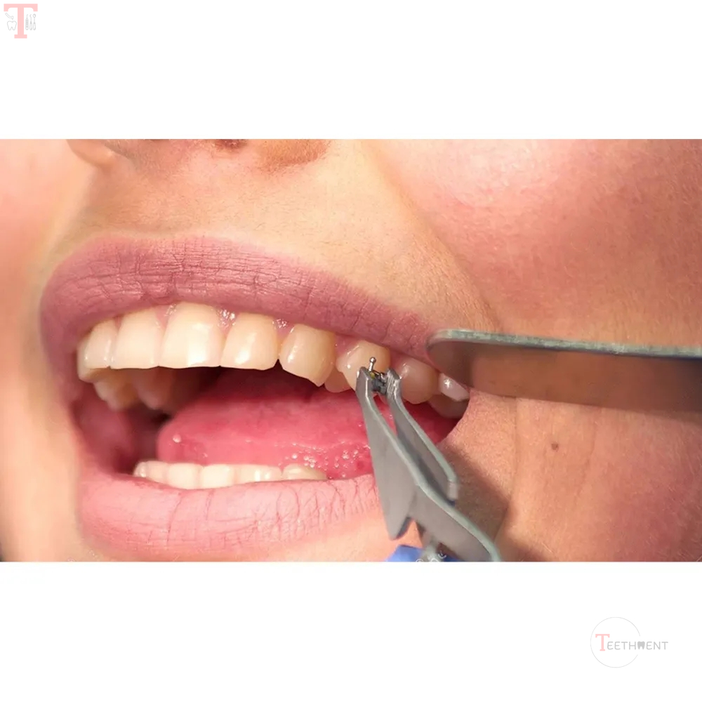 GDC Bracket Holding Tweezer With Flap 1006_5.jpg