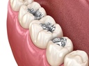 Dpi Dental Amalgam AlloyNonGamma 2_3.png