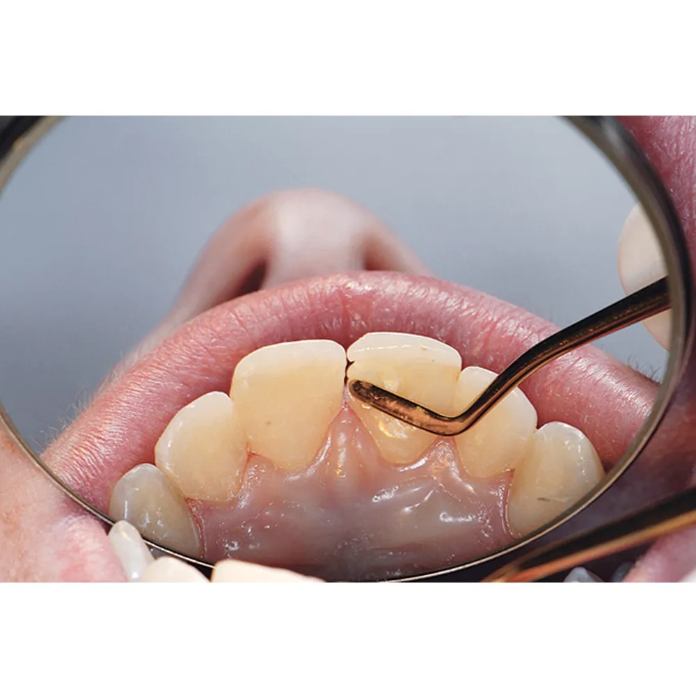 GDC Composite Instrument Flexi Thin Gold Titanium 6 CIGFT3_5.png