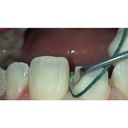 GDC Gingival Cord Packer NonSerrated 4 Gcpr7n_5.png