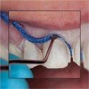 GDC Gingivial Cord Packer Serrated 3 Gcpas113_5.png