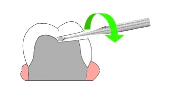 Wamkey Crown  Bridge Remover Kit_4.png
