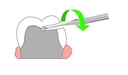 Wamkey Crown  Bridge Remover Kit_4.png