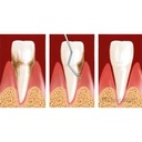 GDC Columbia Curettes 2r2l Anterior Application 6 Sc2r2l_5.png