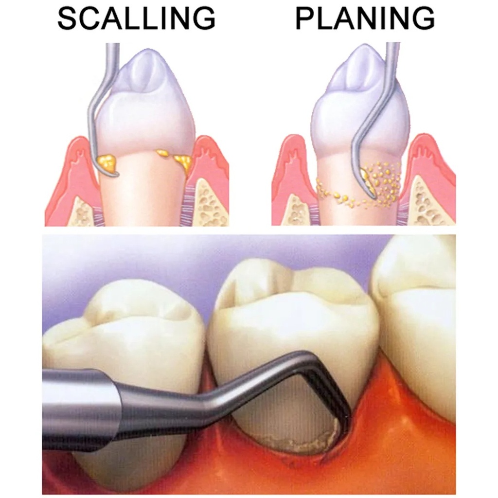 GDC Columbia Curettes 4r4l Posterior Application 6 Sc4r4l_4.png