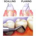 GDC Columbia Curettes 4r4l Posterior Application 6 Sc4r4l_4.png