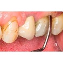 GDC Columbia Curettes 4r4l Posterior Application 6 Sc4r4l_5.png