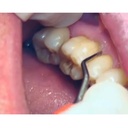 GDC Gracey Curettes Cc Mesial Surfaces Of Posterior Teeth  7 Sgcc1112_5.png
