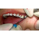 GDC Gracey Curette CC PremolarsMolarsFacialLingual Surfaces 7 Sgcc78_5.png