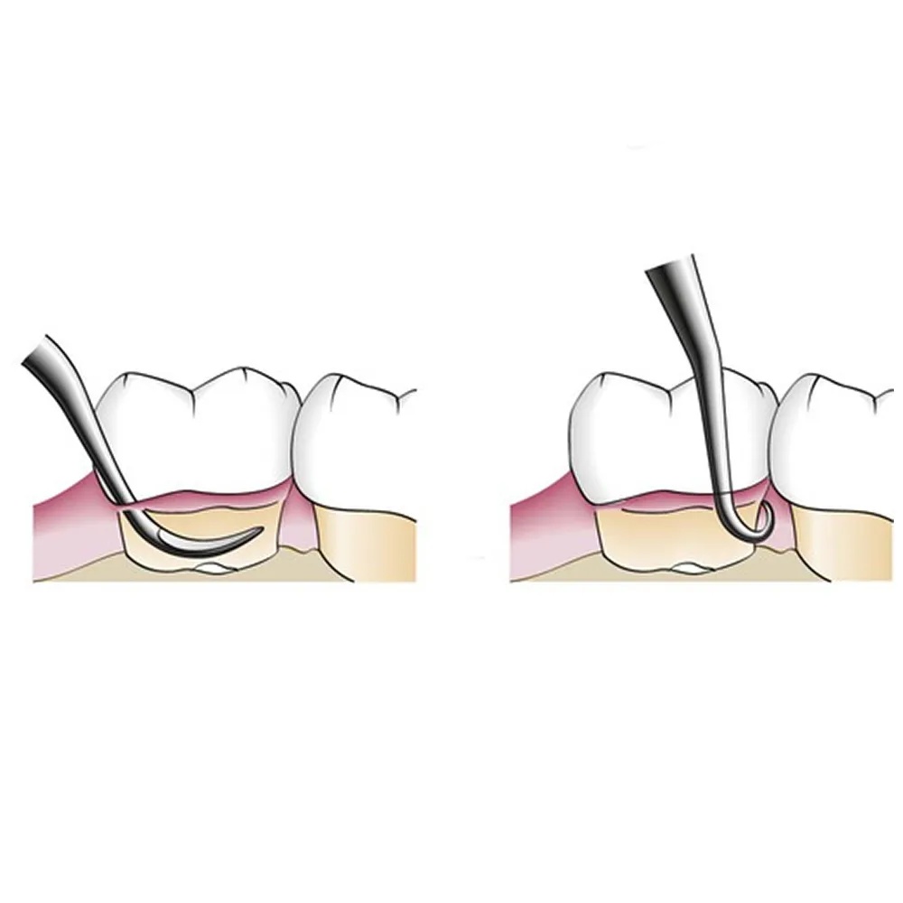 GDC Gracey Curettes Cc Distal Surfaces Of Posterior Teeth  7 Sgcc1314_5.png
