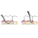 GDC Gracey Curettes Cc Distal Surfaces Of Posterior Teeth  7 Sgcc1314_5.png