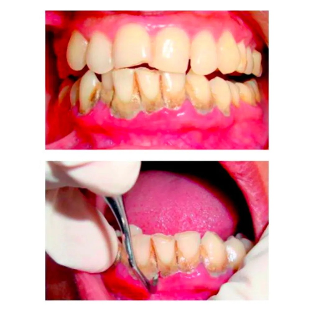 GDC Gracey Curettes 6 Sg1314_5.png