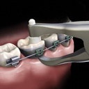 GDC Posterior Band RemoverLong Plier 300050_4.png