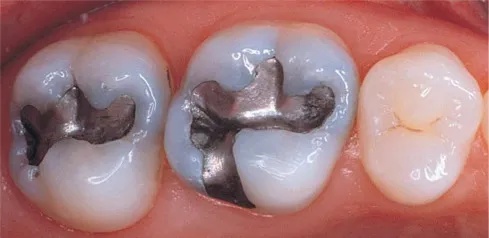Dpi Dental Amalgam Alloy-Non-Gamma 2
